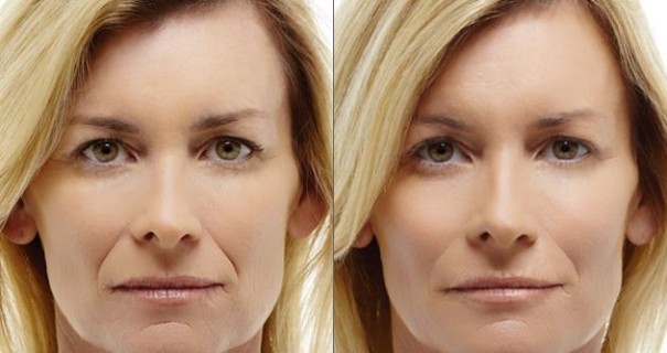 Radiesse San Diego La Jolla Cosmetic Surgery Centre 9200