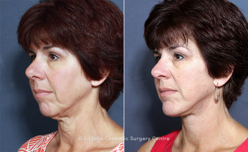 Dr. Brahme Rhinoplasty and Chin Enlargement | La Jolla Cosmetic Surgery