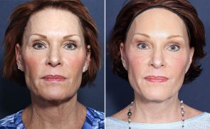 Brow Lift Before After Photos San Diego La Jolla Cosmetic Surgery Centre Forehead Lift Images