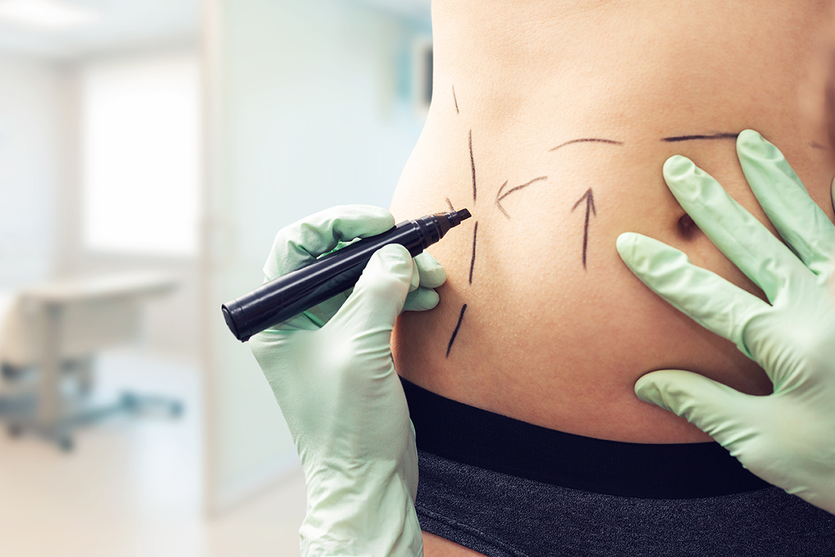 6 Ways Liposuction Is Better Than CoolSculpting® 6 Ways