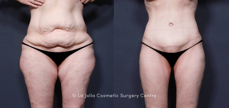 Body Contouring and Skin Removal Surgery