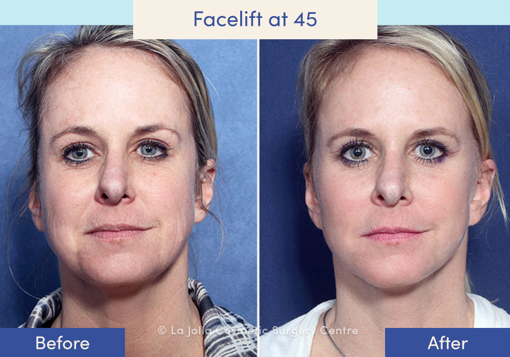 Facelift Before & After Photos: What a Facelift Looks Like at 40, 50, 60 &  70, Facelift in San Diego, CA
