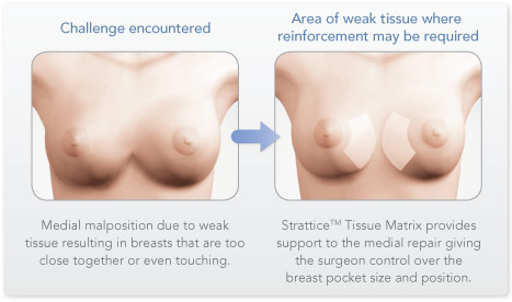 Common Causes for Sagging Breasts and How to Treat Them – Synergy Plastic  Surgery