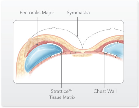 Treatment for Symmastia, Strattice Tissue Matrix