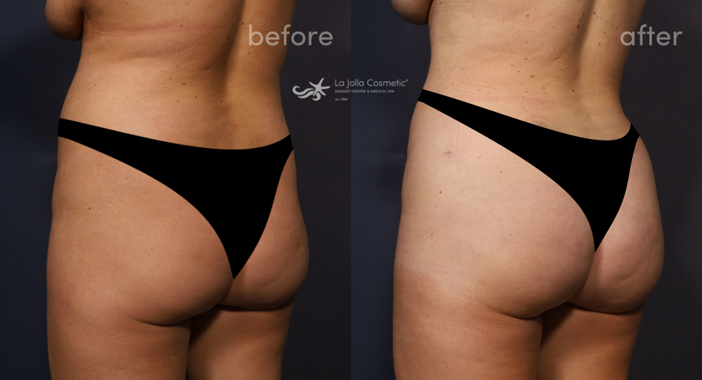 Post Op Stage 2 360 Body Lipo Butt Lifter Slimming High Quality