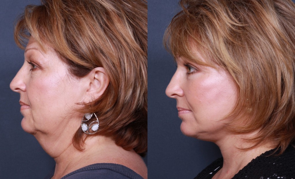 Dr. Brahme Neck Lift 921 - La Jolla Cosmetic Surgery Centre