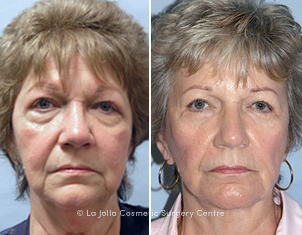 Dr. Smoot Face Lift - La Jolla Cosmetic Surgery Centre